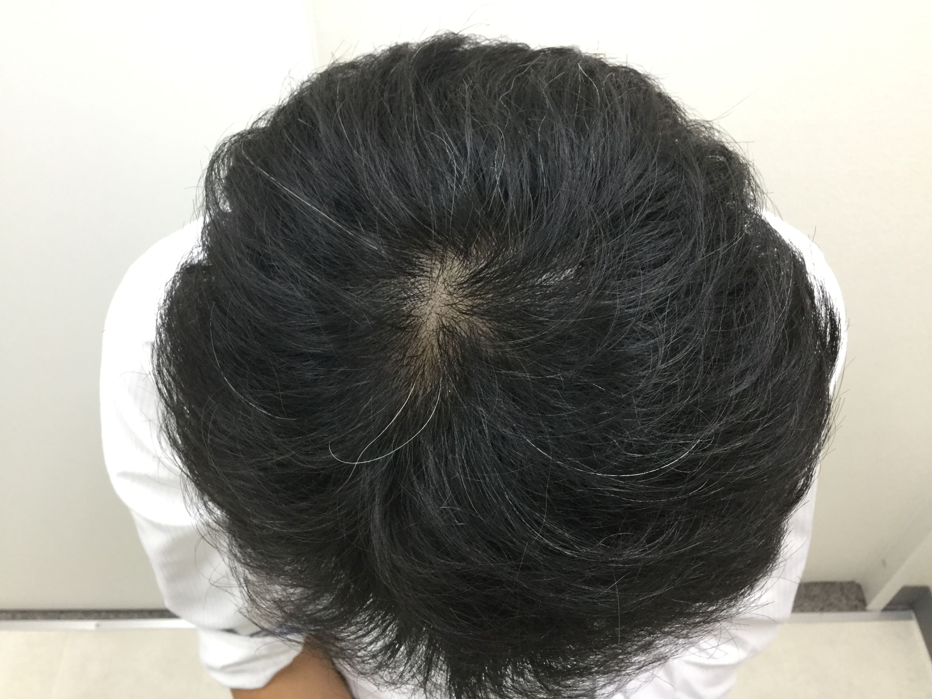 AGA治療前　42歳男性　頭頂部　新宿AGAクリニック