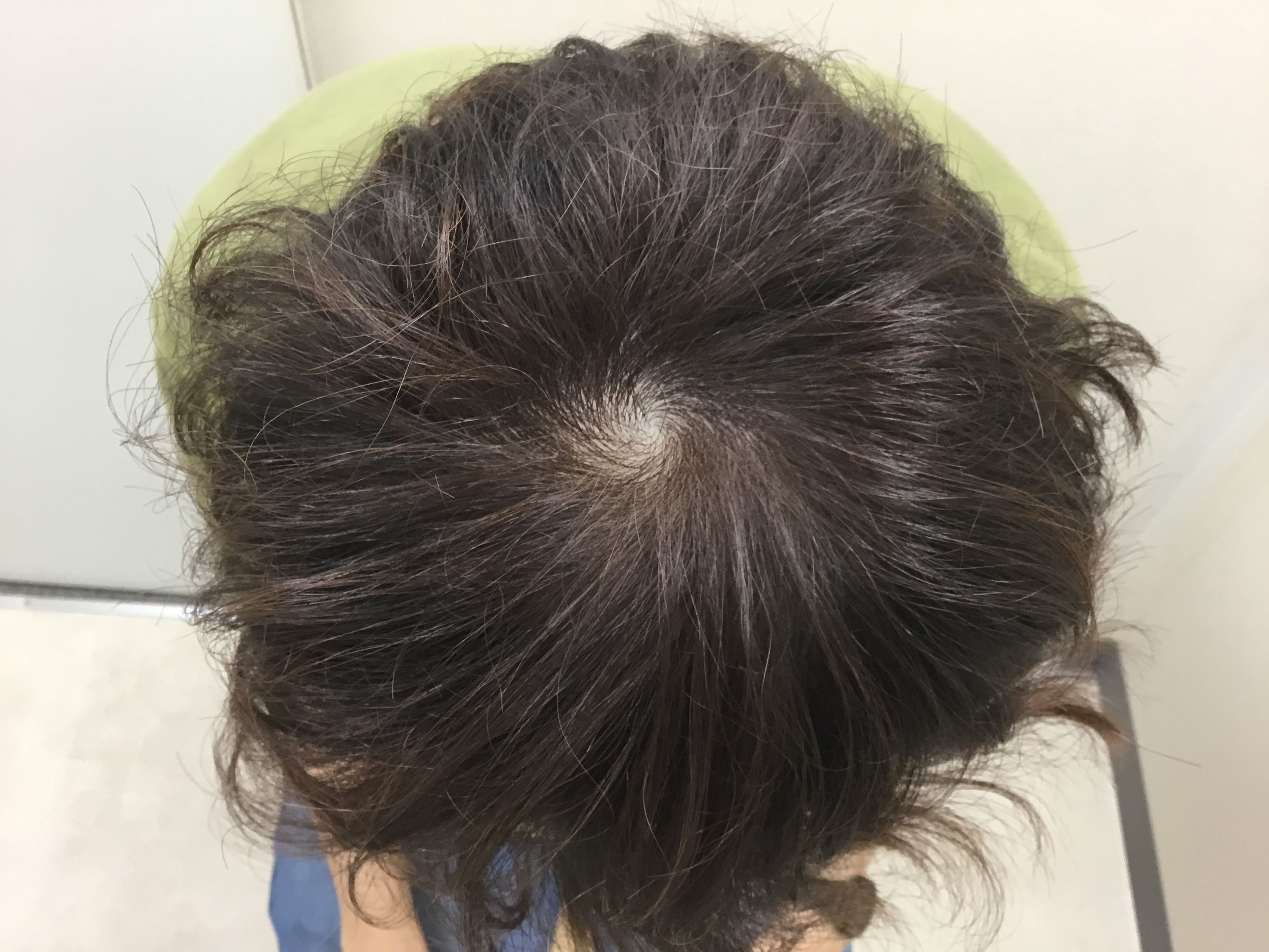 AGA治療前　28歳男性　頭頂　新宿AGAクリニック