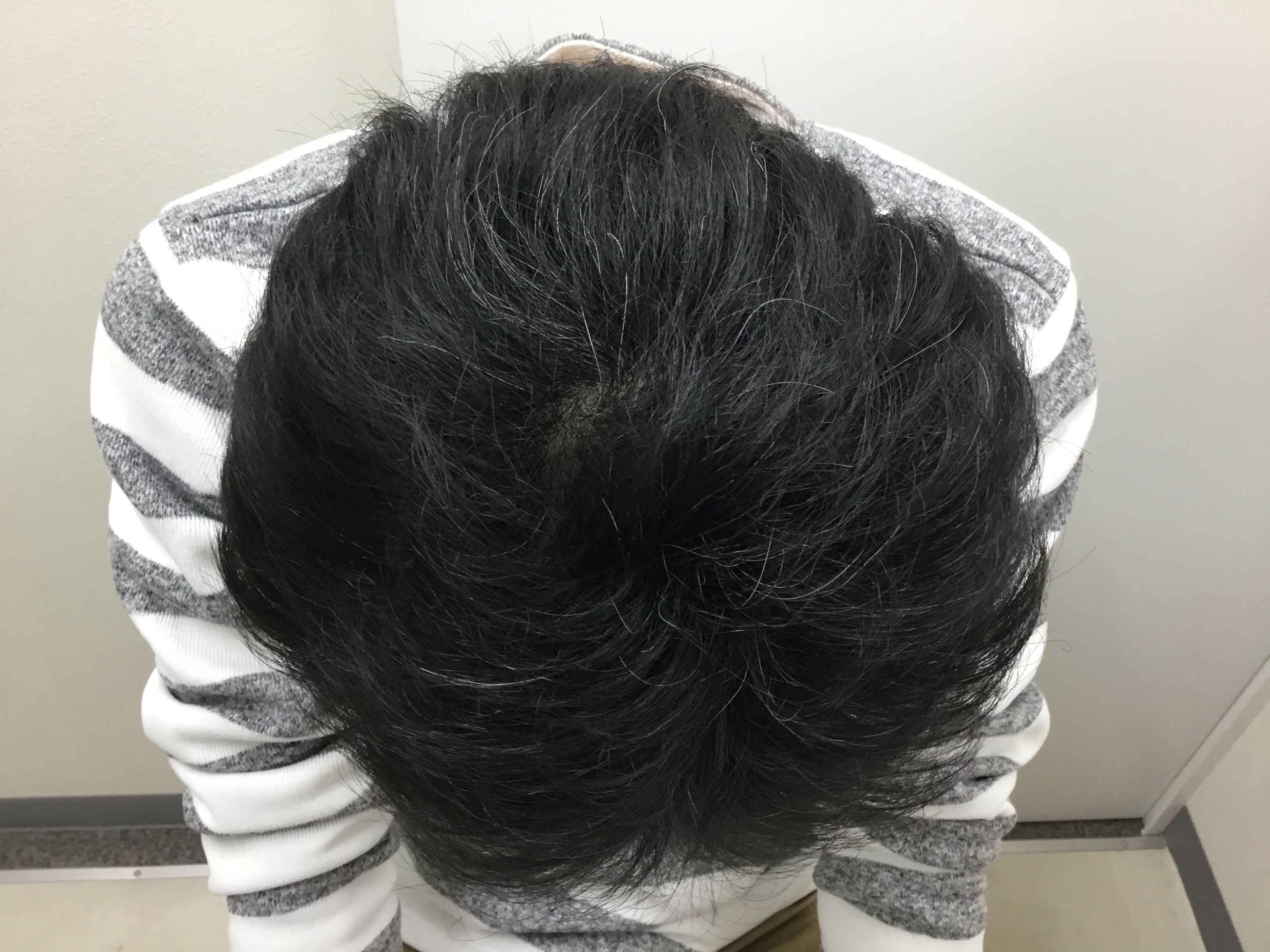 AGA治療後　42歳男性　頭頂部　新宿AGAクリニック