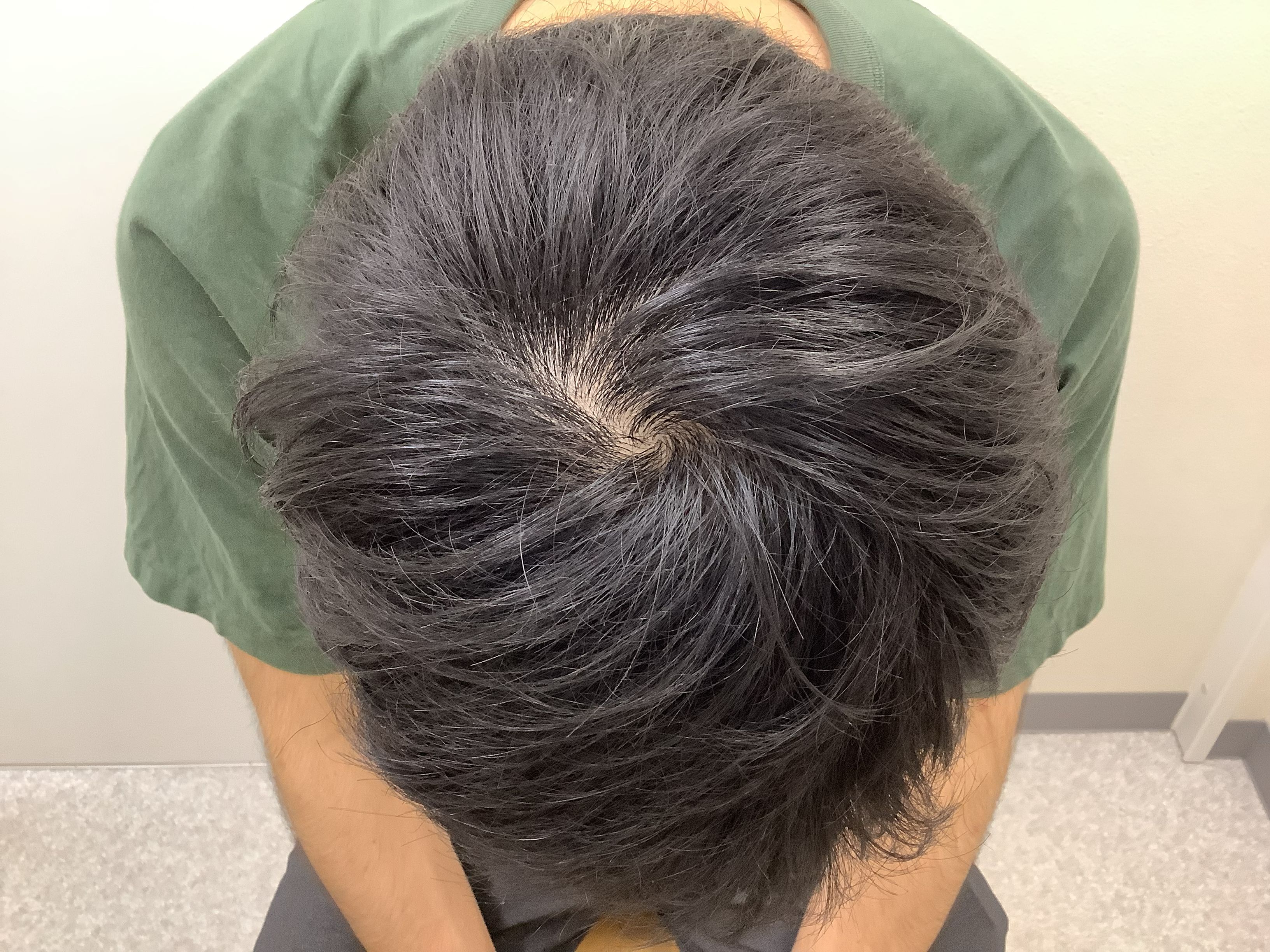 AGA治療後　25歳男性　頭頂部　新宿AGAクリニック
