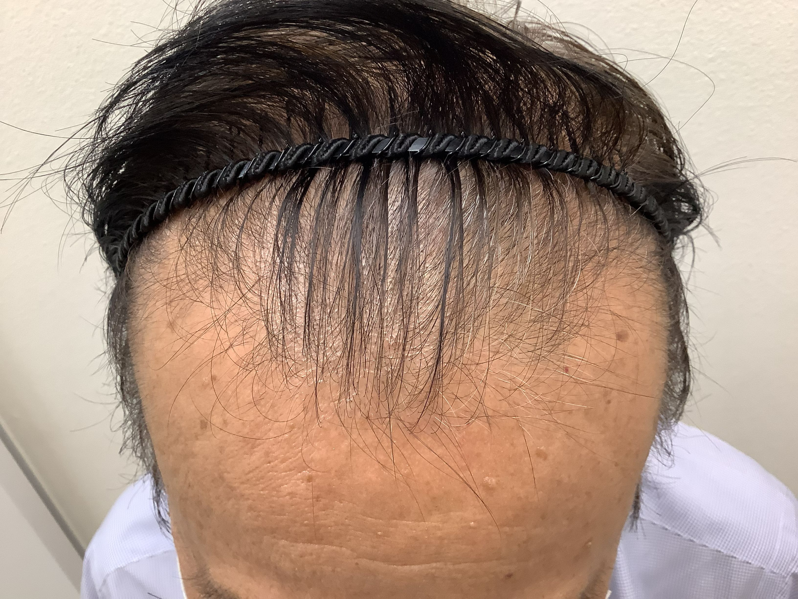 AGA治療前　76歳男性　生え際　新宿AGAクリニック