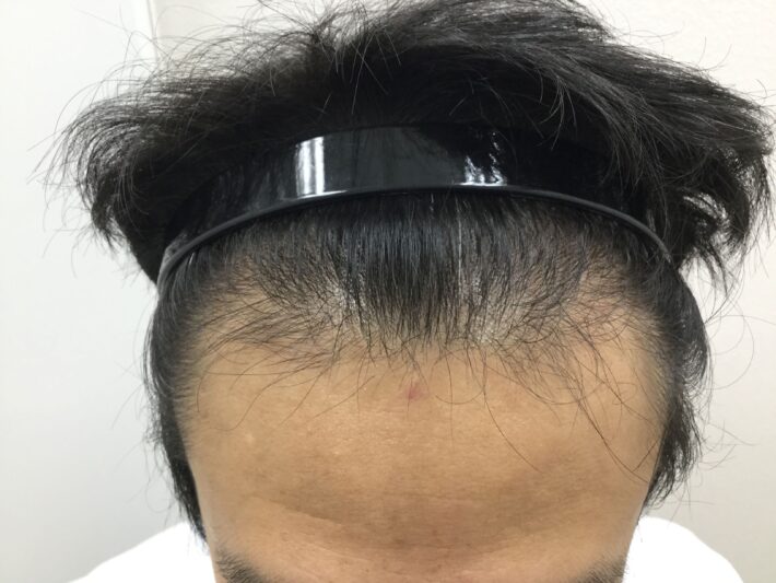 before