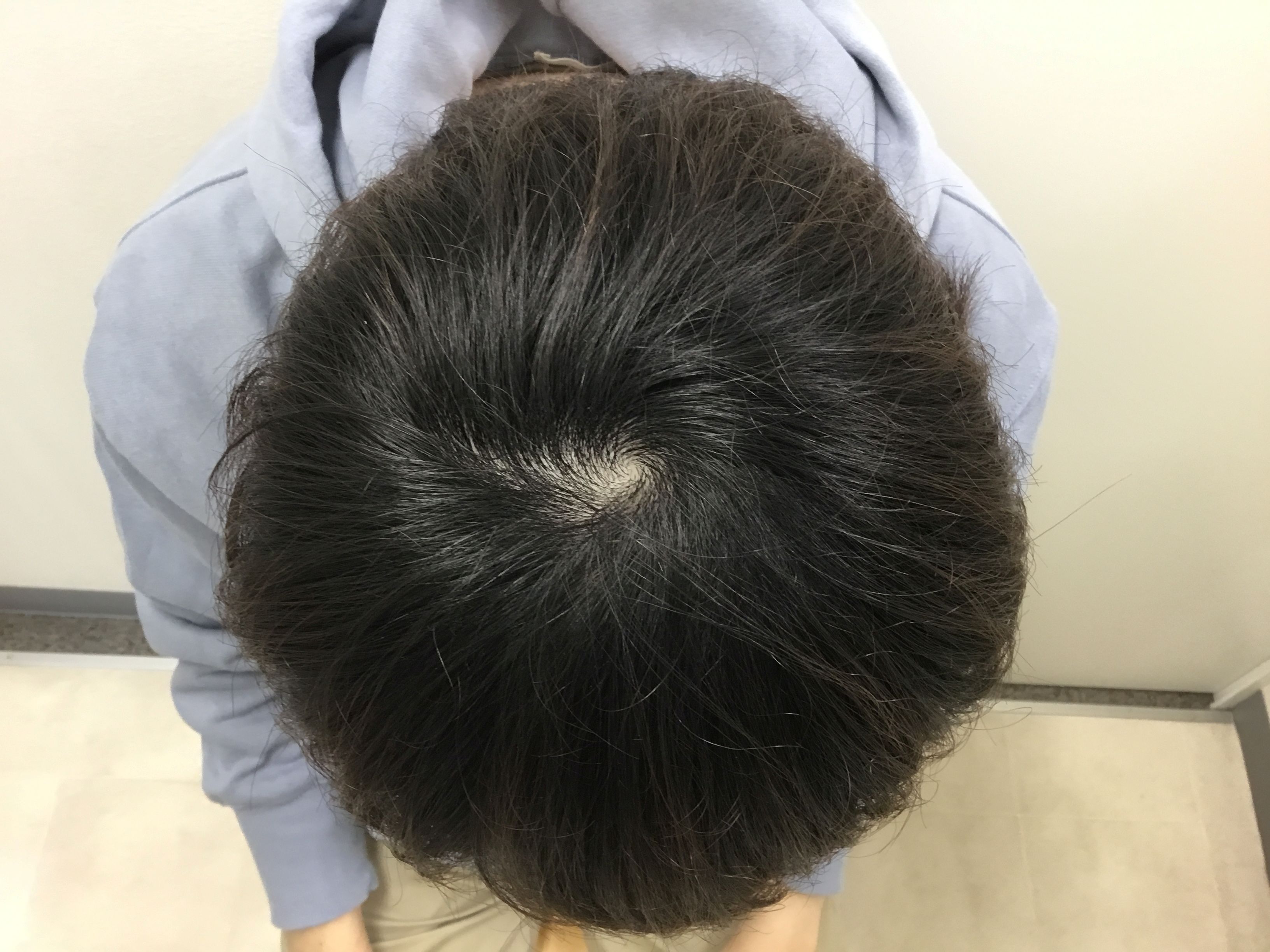 AGA治療後　28歳男性　頭頂　新宿AGAクリニック