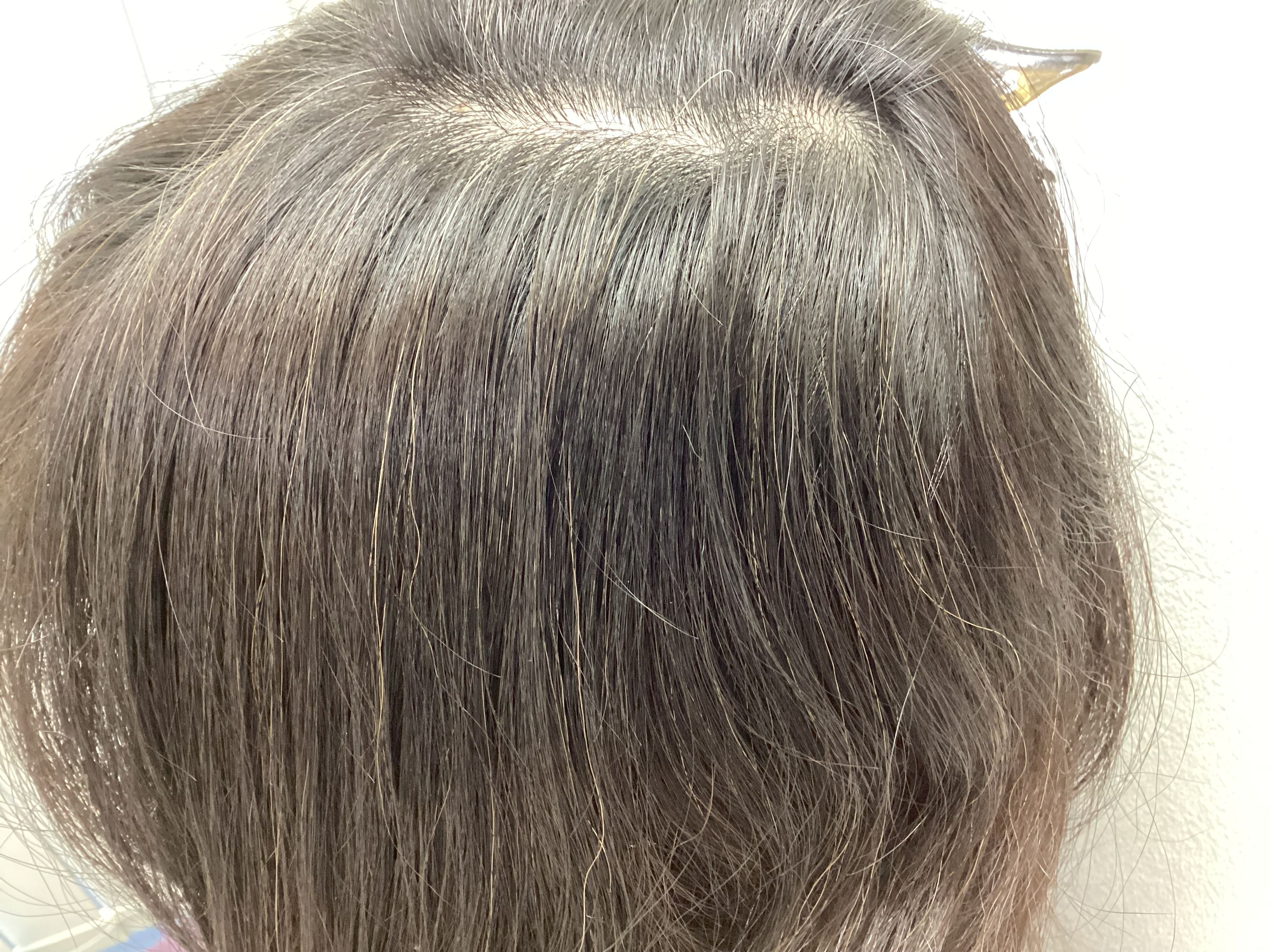 円形治療後　53歳女性　左側頭部（拡大）　新宿AGAクリニック