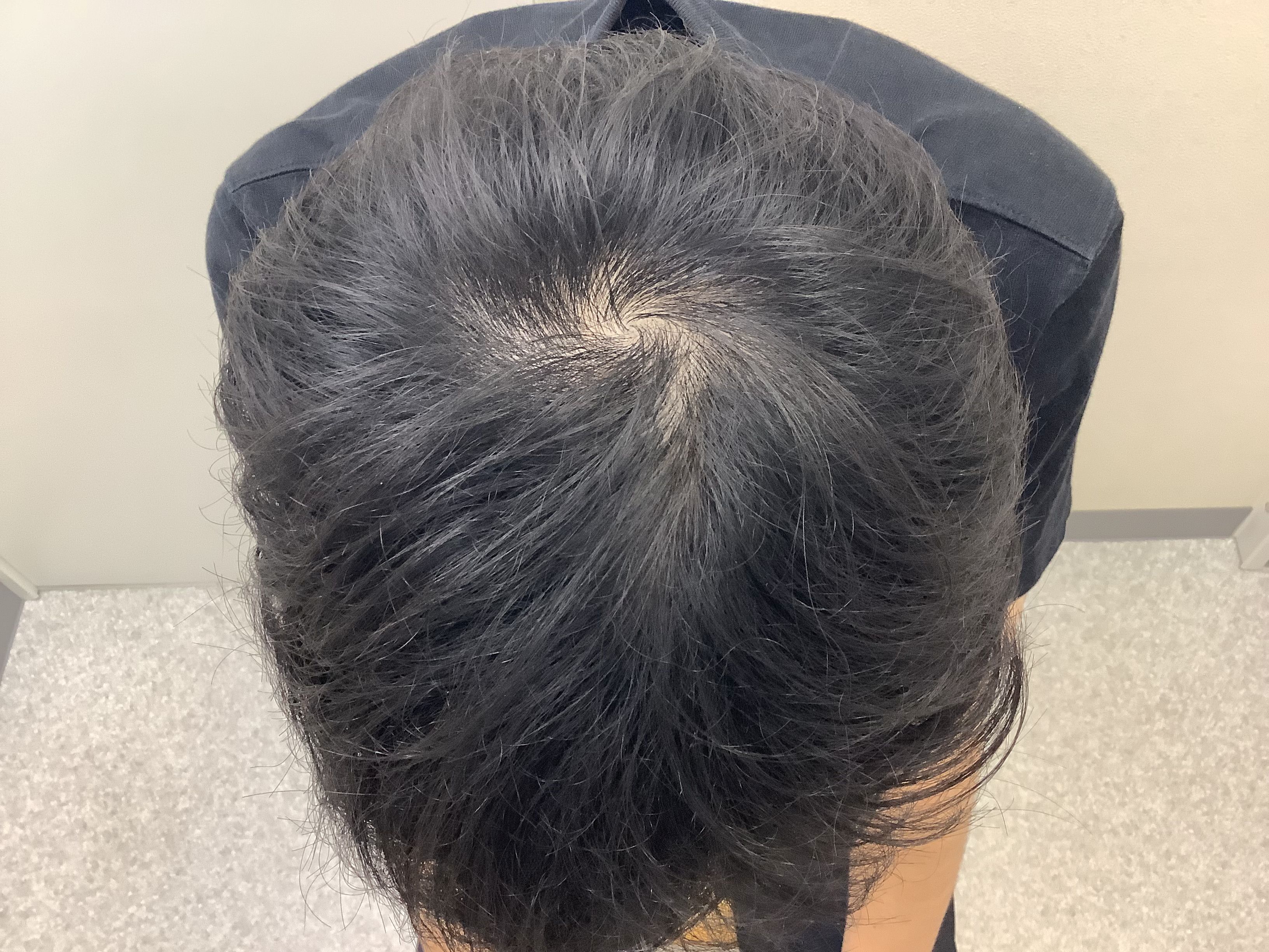 AGA治療前　25歳男性　後頭部　新宿AGAクリニック