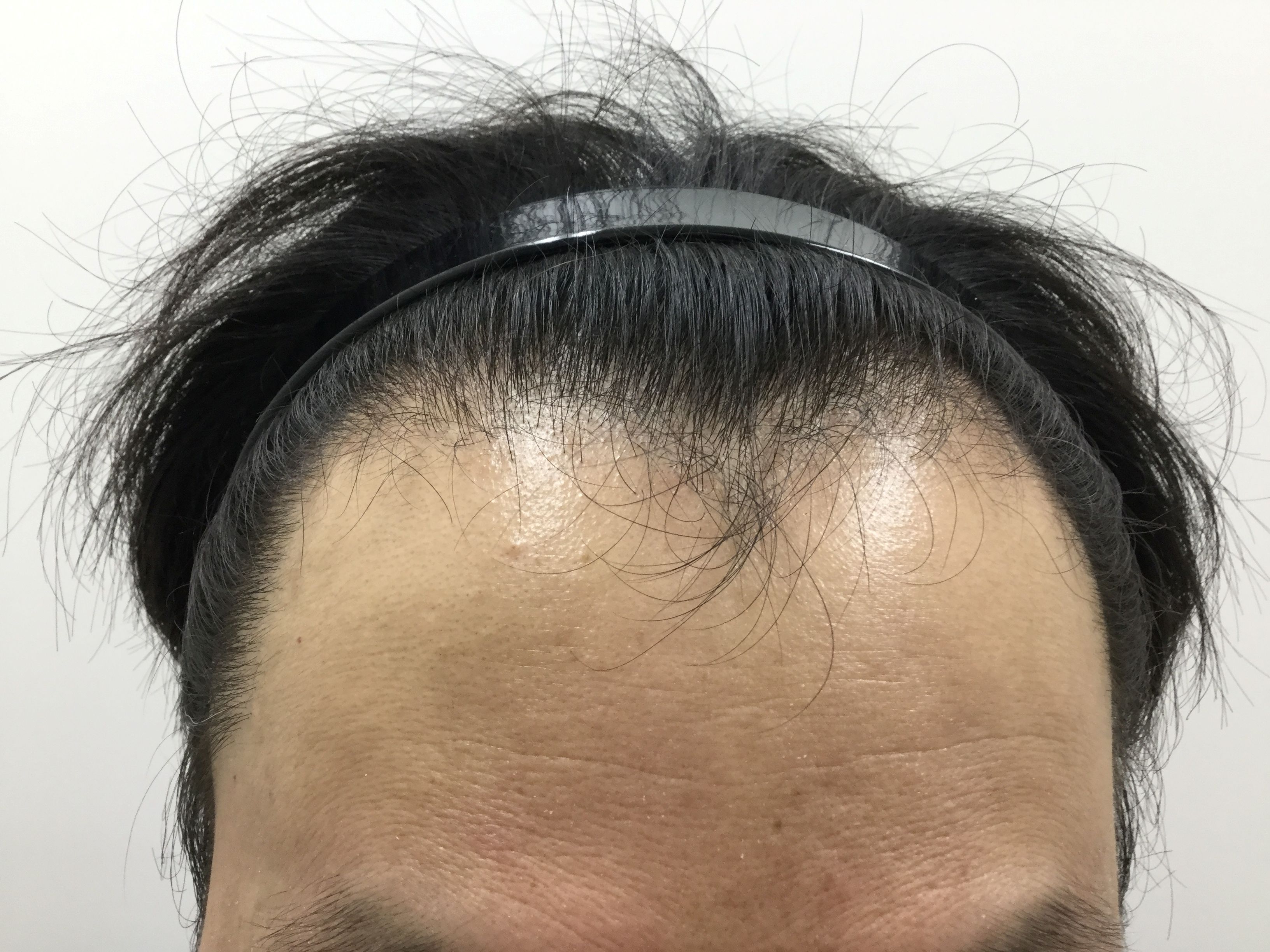 AGA治療前　43歳男性　生え際　新宿AGAクリニック