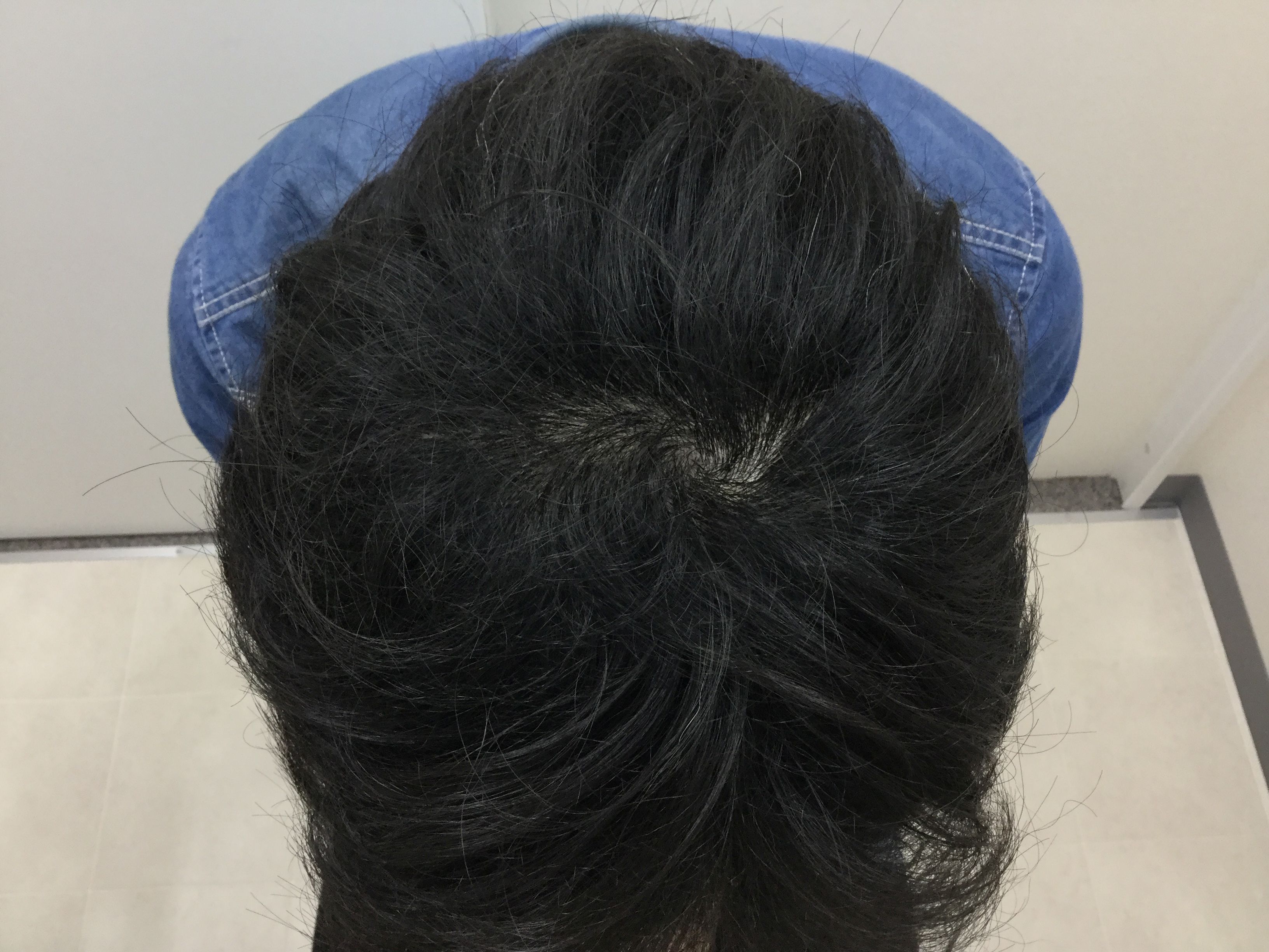 AGA治療後　43歳男性　頭頂部　新宿AGAクリニック