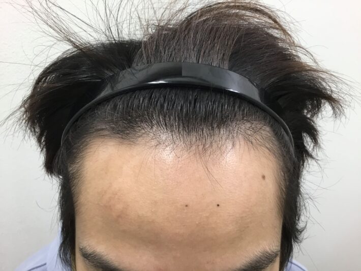 after