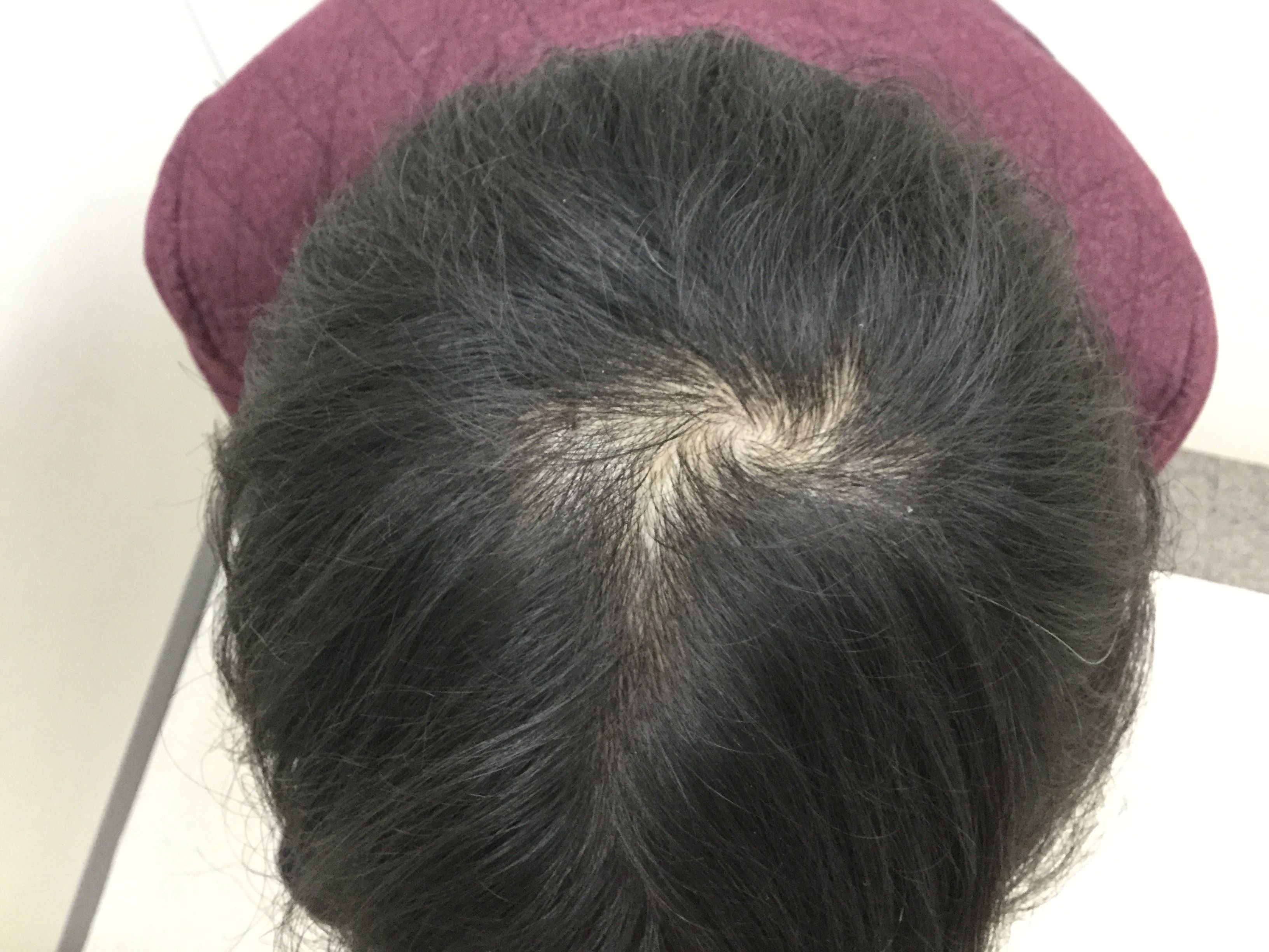 AGA治療前　43歳男性　頭頂部　新宿AGAクリニック