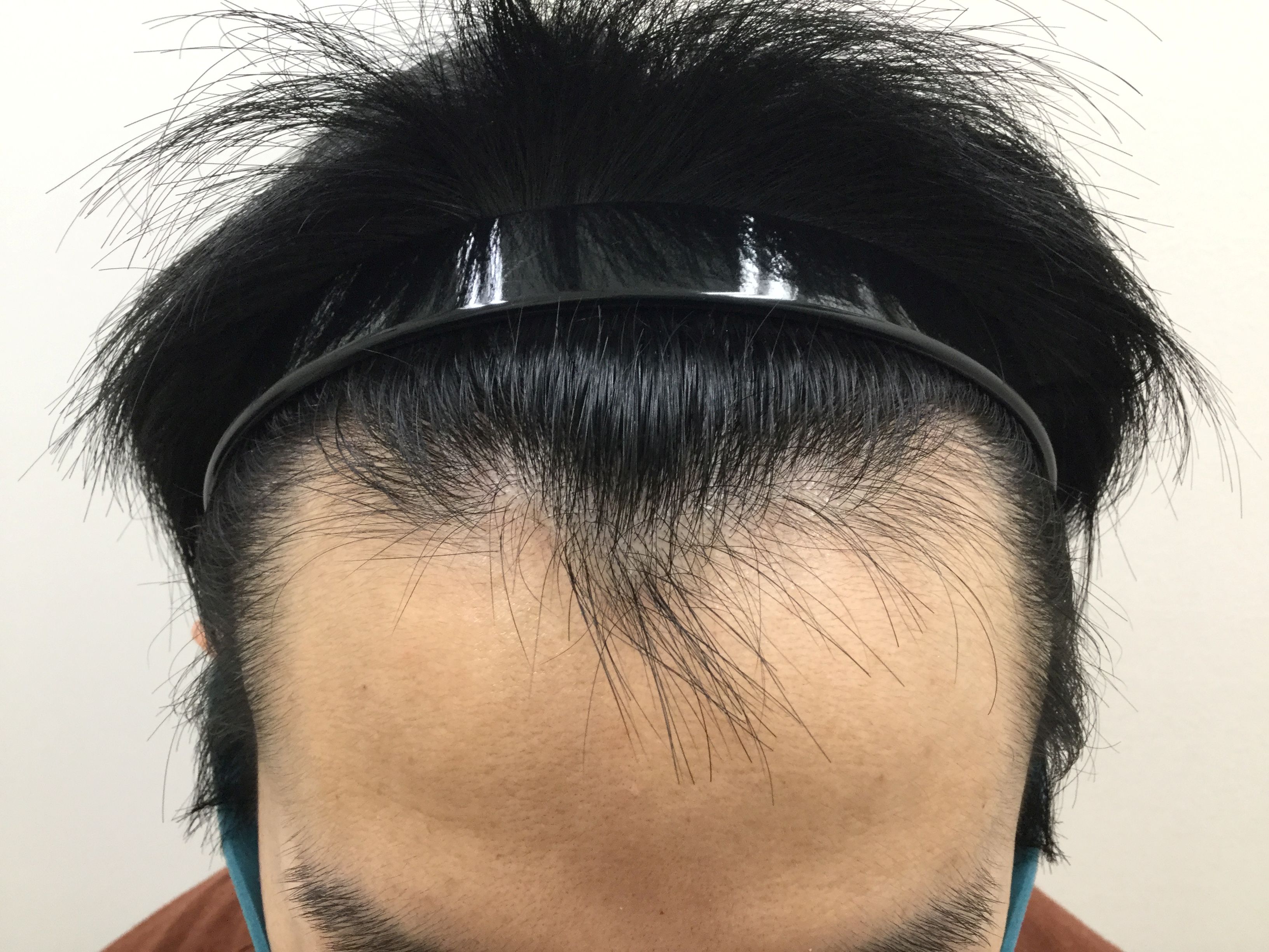 AGA治療前 36歳男性 生え際 新宿AGAクリニック
